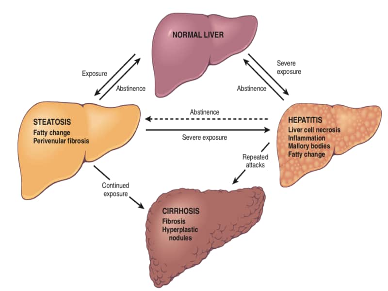 What are 4 Warning Signs of a Damaged Liver?